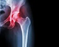 वैज्ञानिकों ने जोड़ों के कार्टिलेज के पुनर्विकास के जिम्मेदार प्रमुख तत्व का पता लगाया