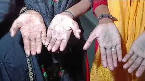 फैक्ट्री में बच्चों से बर्बरता से कराया जा रहा था काम